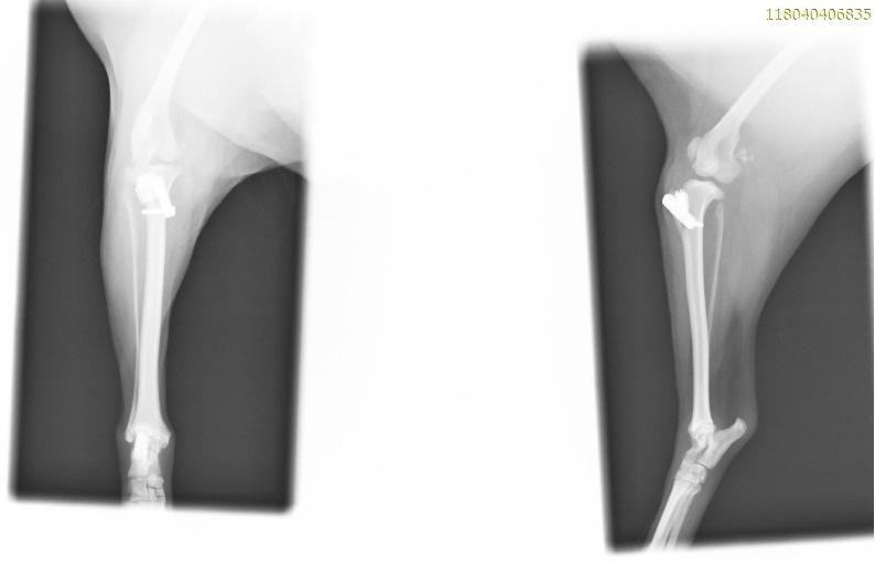 Traitement post-chirurgical d’une rupture du ligament croisé antérieur avec fracture tibiale via la radiofréquence à 448 KHz capacitive et résistive
