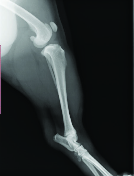 Traitement d’une rupture du ligament croisé antérieur avec la radiofréquence capacitive et résistive à 448 KHz