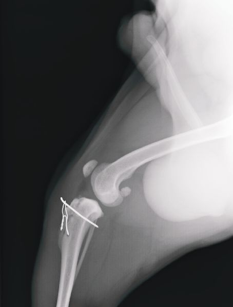 Traitement d’une rupture du ligament croisé antérieur avec la radiofréquence capacitive et résistive à 448 KHz