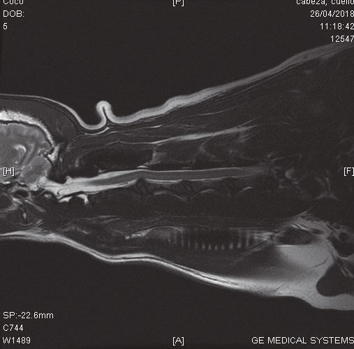 Spasticité musculaire avec lésion de la moelle épinière, traitement par radiofréquence à 448 KHz