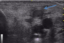 radiographie jarret cheval thromborphlebite