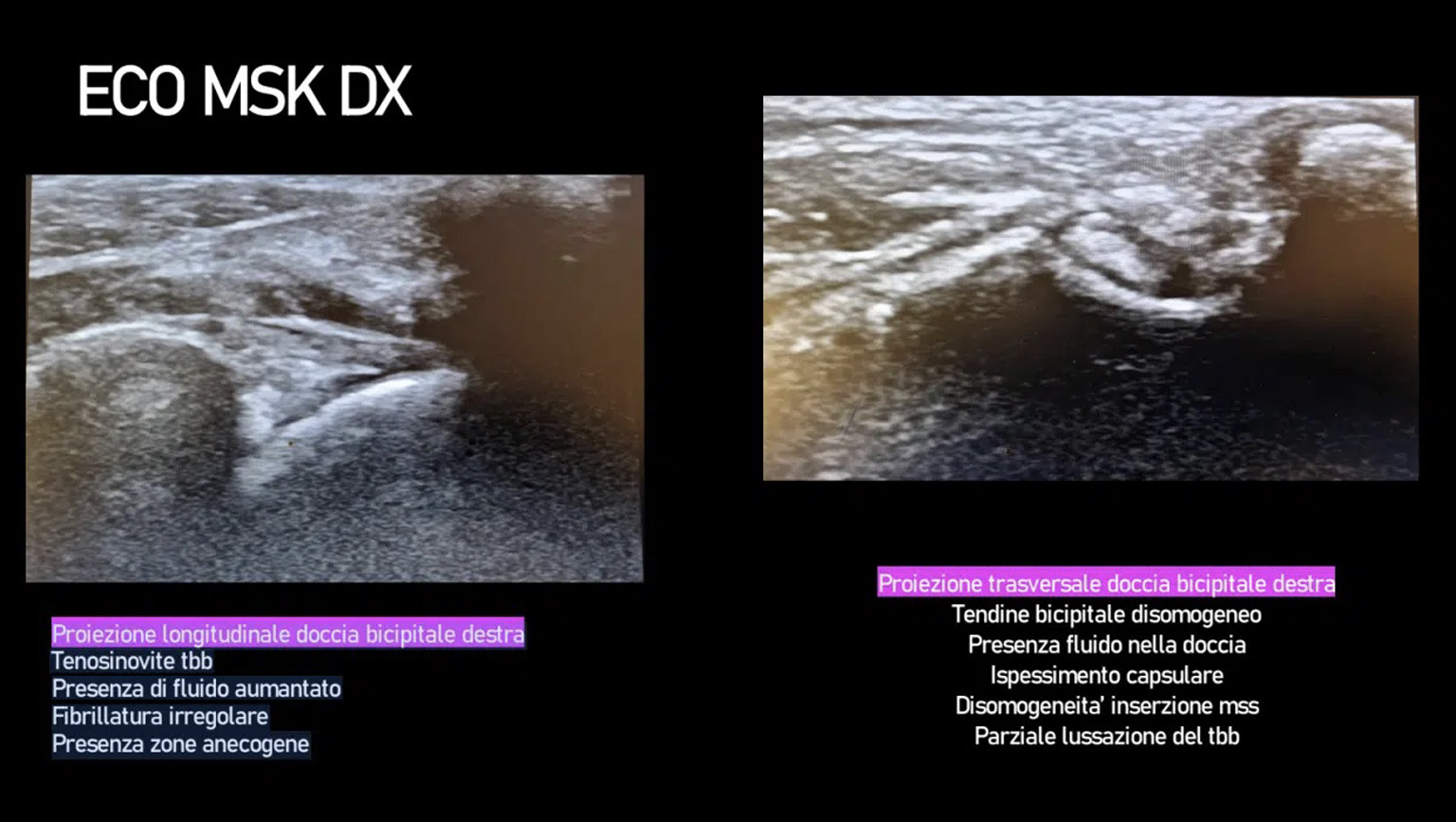 Cas clinique tendinopathie echographie resultats 2