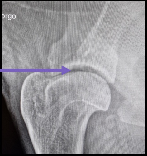 Cas clinique tendinopathie radio diagnostic